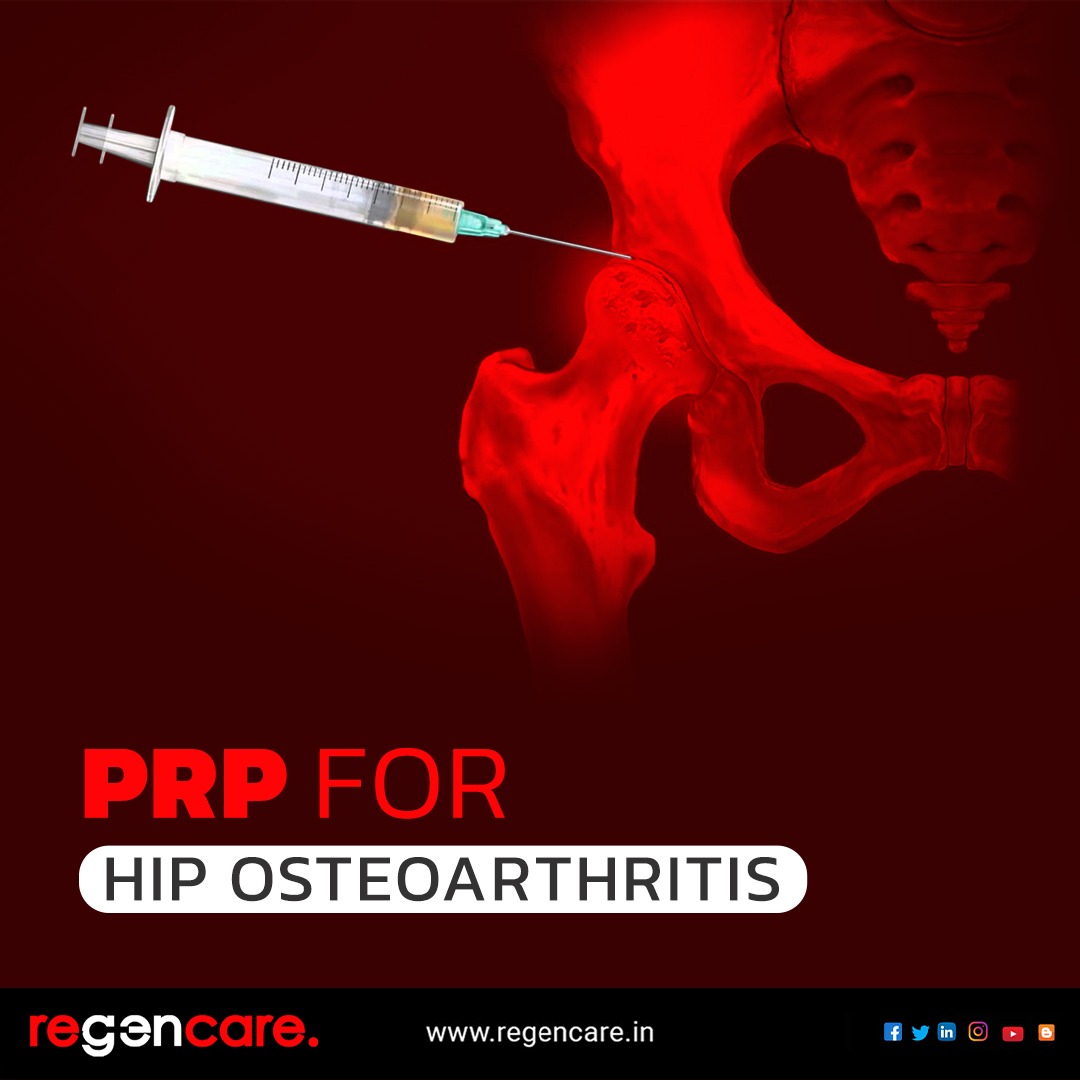 PRP treatment for hip osteoarthritis in Kochi - Regencare